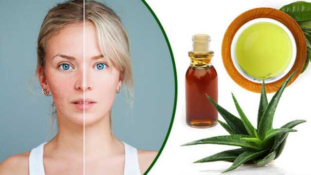 acne-rosacea-natural-treatment-and-diet