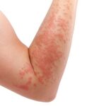 what-causes-hives-and-how-to-never-get-it
