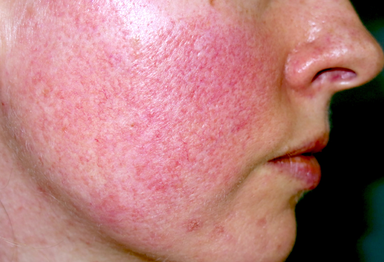 Facial Redness Not Rosacea Rosacea Symptoms Causes Types And 