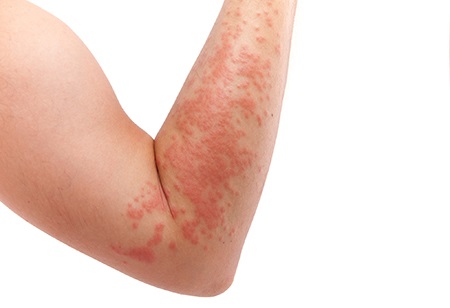 what-causes-hives-and-how-to-never-get-it